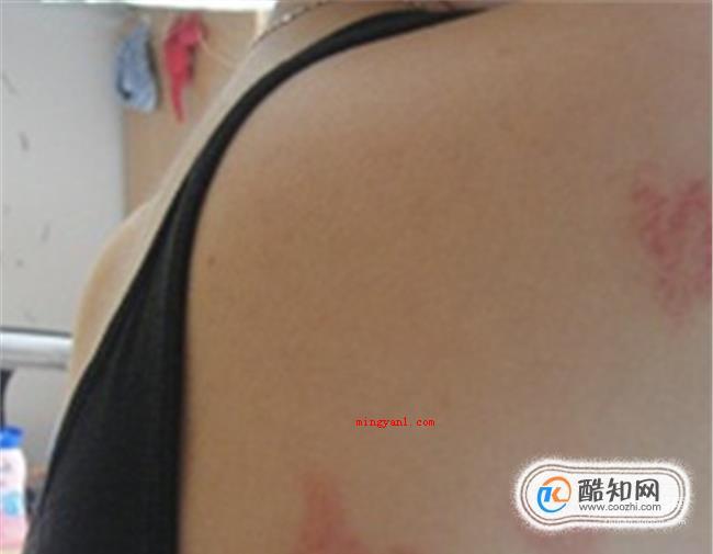 螨虫叮咬后的症状图