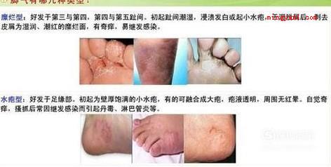 足癣图片大全（大伙儿了解足癣有哪些吗?）