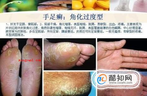 足癣图片大全（大伙儿了解足癣有哪些吗?）