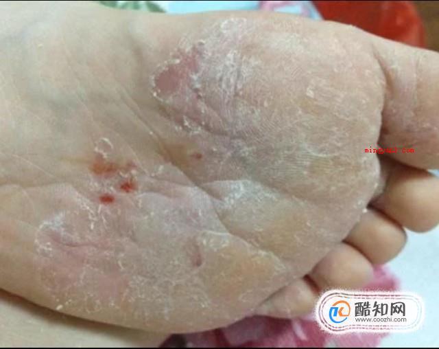 足癣图片大全（大伙儿了解足癣有哪些吗?）
