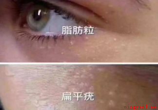眼下颗粒怎么办 该如何处理眼下颗粒 眼下颗粒怎么办 最好的办法还是去医院找专业医生处理