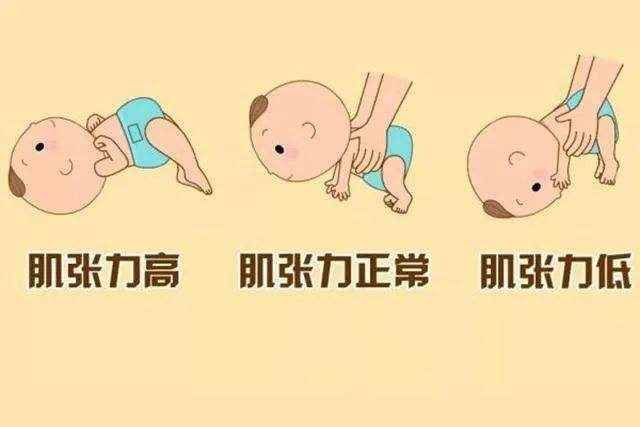 肌张力高几个月会消失