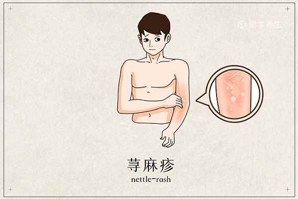 荨麻疹1.jpg 荨麻疹初期症状图片(荨麻疹的早期症状有哪些)
