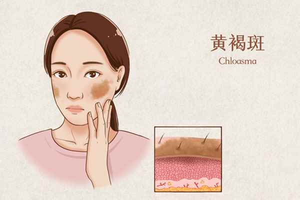 600黄褐斑医疗插画(企业商用).jpg 藏红花能去黄褐斑吗