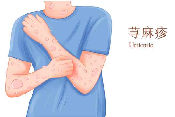 摄图网_401804282_banner_皮肤病过敏性荨麻疹医疗插画(企业商用).jpg 海鲜过敏症状