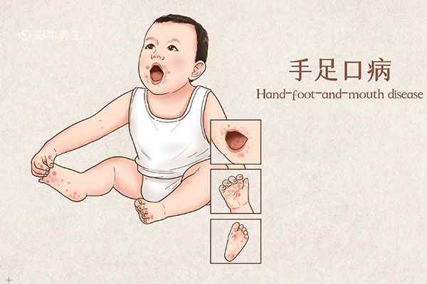 手足口病3.jpg 小儿手足口最早期症状