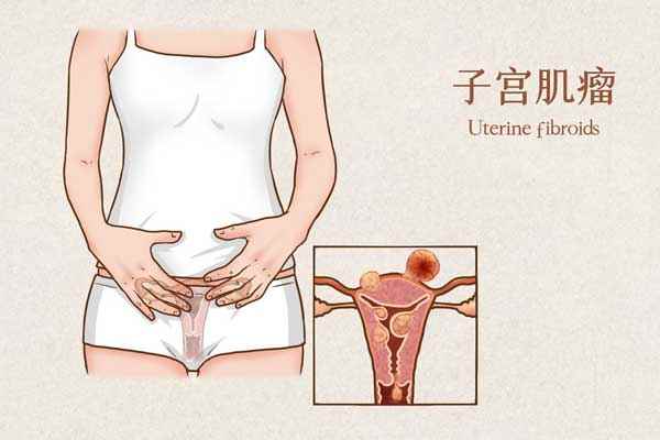 子宫肌瘤医疗.jpg 子宫肌瘤哪些食物不能吃