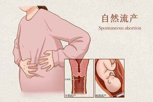 自然流产医疗插画(企业商用).jpg 小产后吃什么有利于恢复