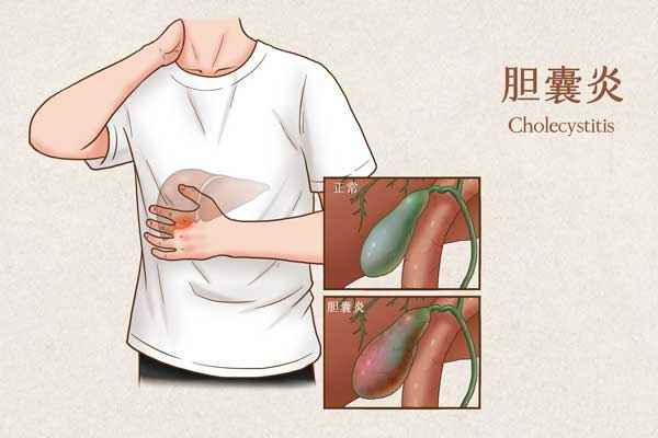 _胆囊炎医疗插画(企业商用).jpg 哪些东西胆囊炎不能吃(胆囊炎患者应保持清淡饮食的原则)