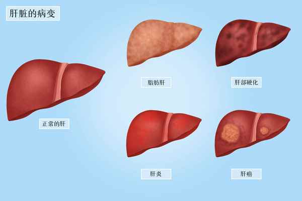 摄图网_401948450_banner_肝脏的病变医疗插画(企业商用).jpg 脂肪肝吃什么好