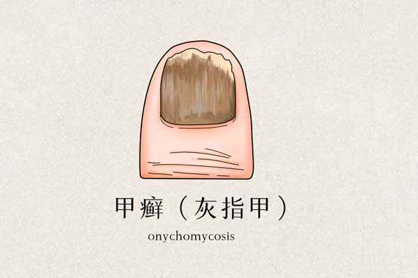 甲癣灰指甲医疗.jpg 灰指甲是什么病