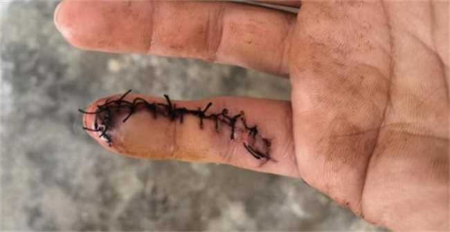 在巢湖探亲休假军人为救人手指被缝13针,徒手操作,拼命挽救