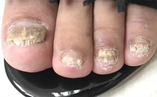 如何鉴别灰指甲严重程度(怎么判断灰指甲想要鉴别)