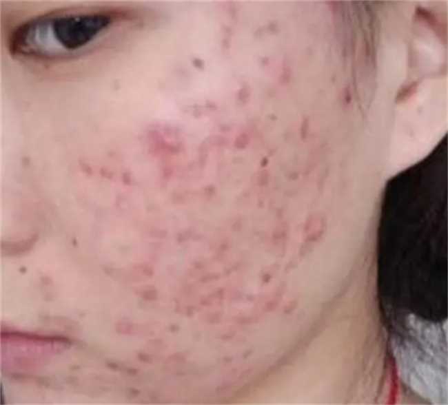 脸上长痘痘如何消除(脸上长痘痘要怎么消除)