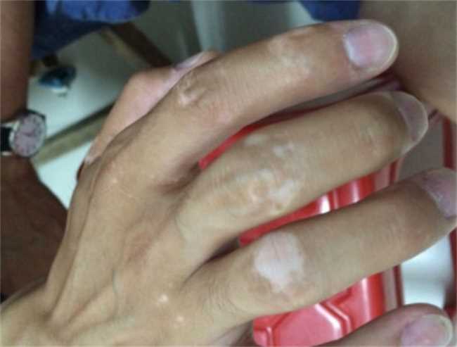 突然长出白斑是什么原因(突然长白斑怎么回事)
