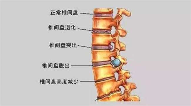 腰间盘突出症不花钱、最简单的治疗方式