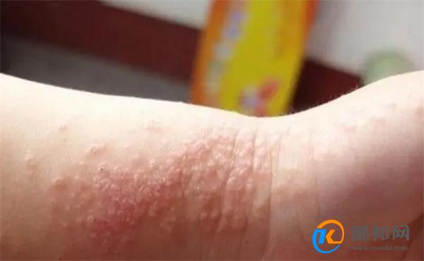 婴儿湿疹怎么处理最好 婴儿湿疹最佳治疗方法