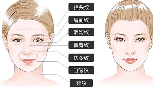 皱眉会产生皱纹么 皱纹去除的方法有哪些