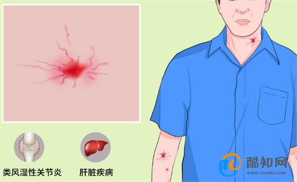 什么是蜘蛛痣 蜘蛛痣会自己消失吗
