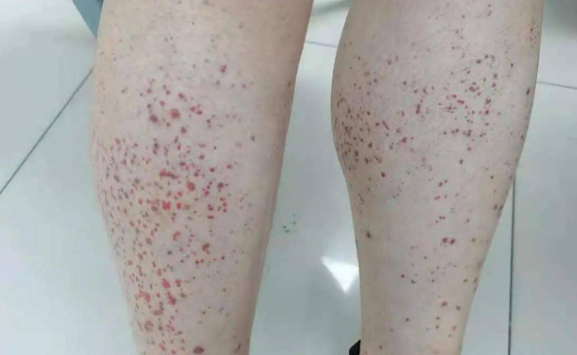 女子称熬夜致免疫力低下确诊紫癜 什么是紫癜