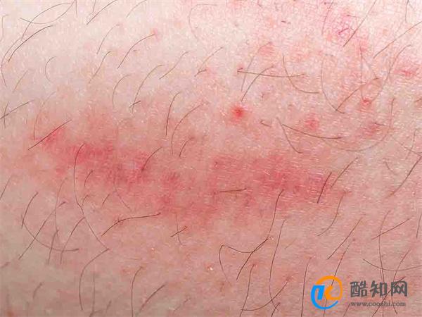 重组带状疱疹疫苗对中国50岁及以上成人保护力如何 保护率多少_酷知科普