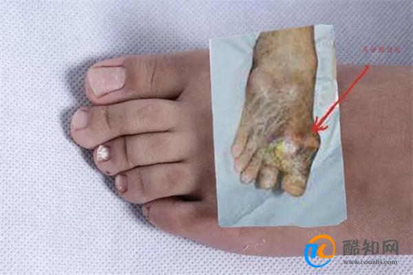 “三高”外的第四高,高尿酸怎么形成的?高尿酸血症等于痛风吗?