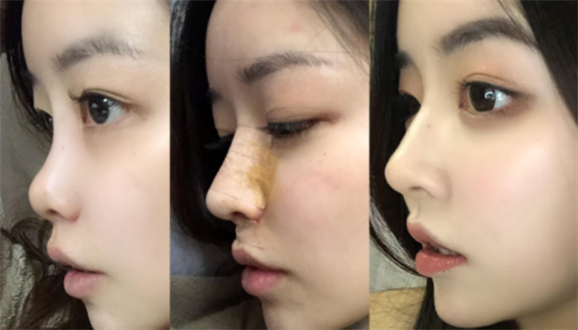 硅胶隆鼻有什么副作用吗 硅胶隆鼻安全吗