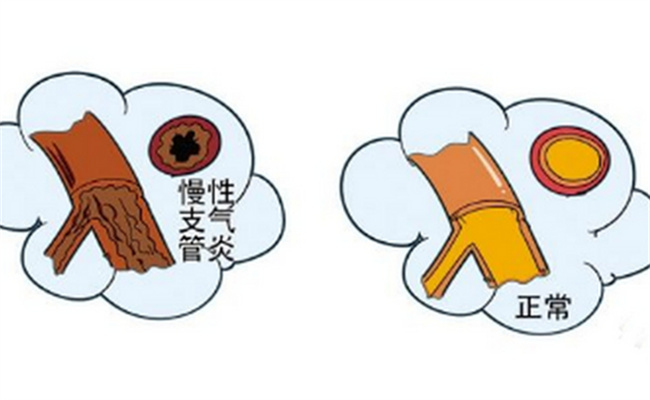 支气管炎的孩子如何保健 支气管炎原因是什么