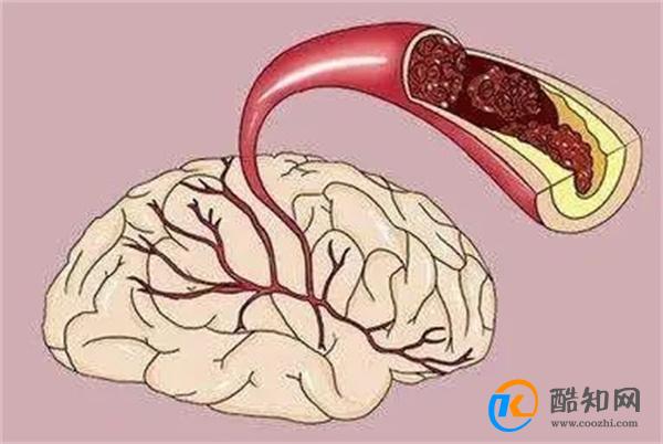 脑梗是“拖”出来的吗?睡觉时若有这3个现象,或要引起重视