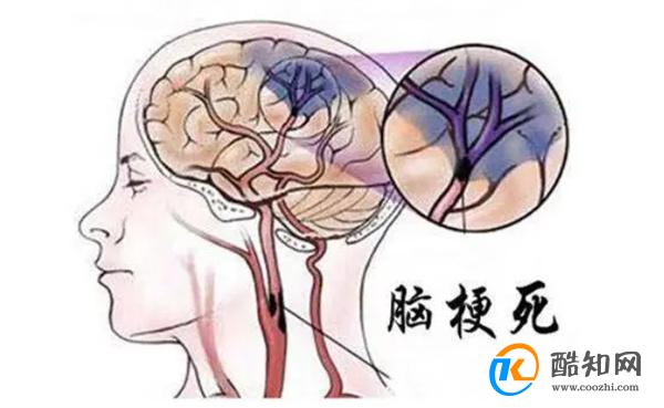 脑梗是“拖”出来的吗?睡觉时若有这3个现象,或要引起重视