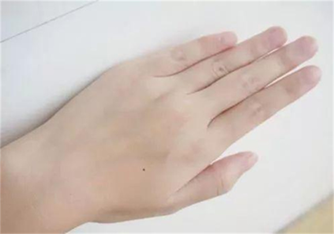 手上长痣好吗