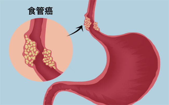 为什么全球超过一半的食道癌在中国,食道癌哪4个症状不可忽略