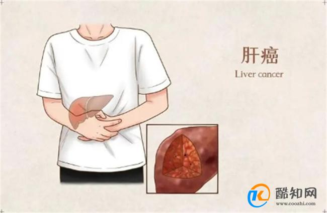 院士:64%肝癌患者初诊时已属中晚期 《2024版共识》的意义
