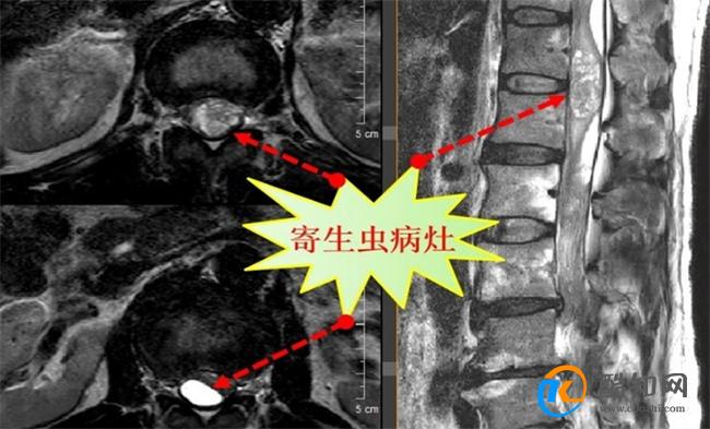 男子吞蛇胆喝蛇药15年后发病 脊髓内寄生虫感染