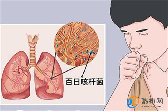 百日咳早期症状与普通感冒相似 百日咳对人体的危害