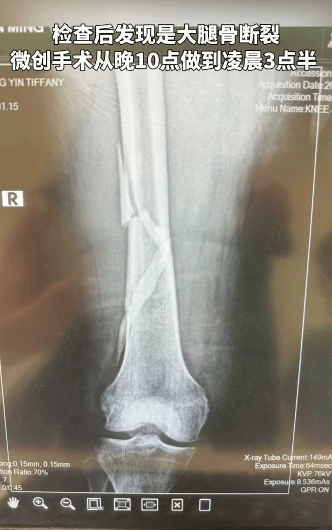 向太浴室摔倒致大腿骨断裂 救治画面曝光:包裹严实被抬进手术室