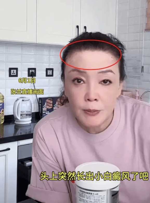 张兰承认患上白癜风!脖子额头都是白斑 心态乐观展女强人本色
